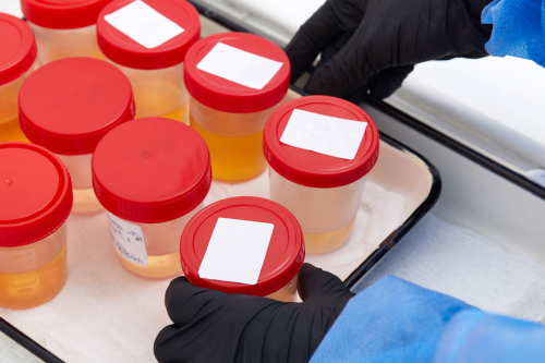 diagnostic packaging and diagnostic test kitting for urine samples